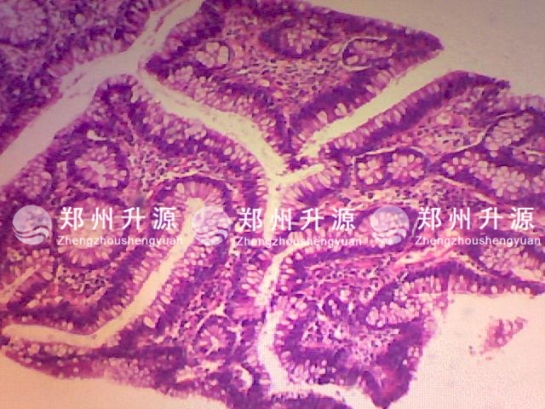 江门肠腺瘤