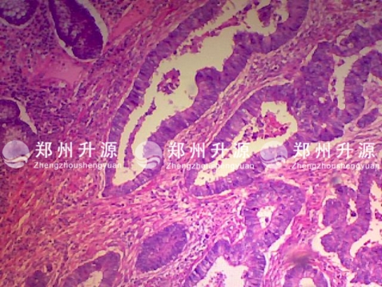 扬州肠腺癌