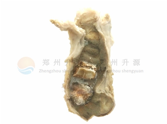 胆囊结石-病理标本